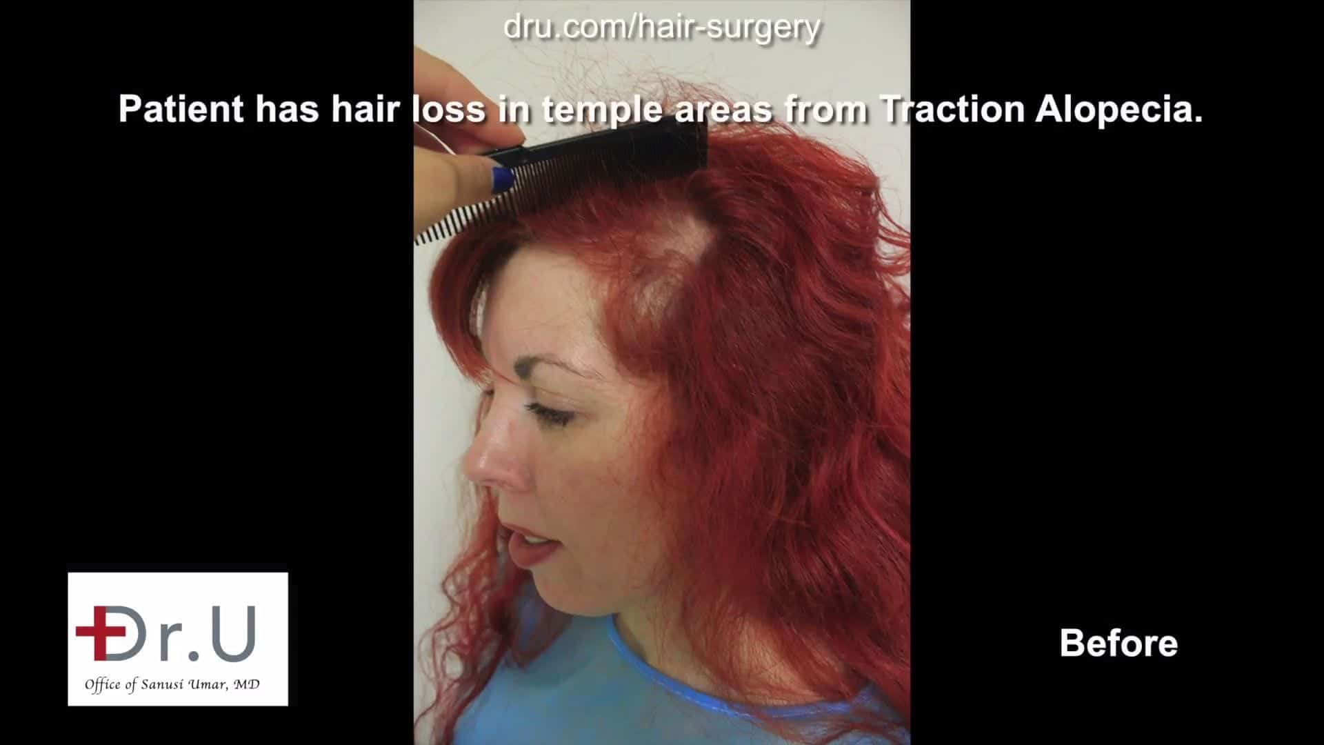 This patient came to Dr. Umar in Los Angles for a traction alopecia treatment.
