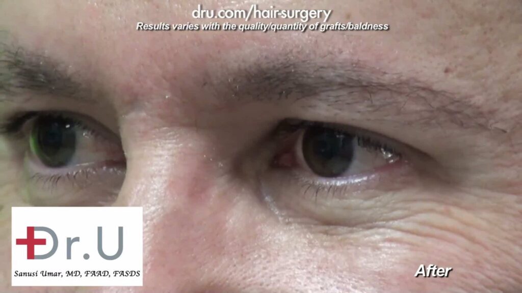 Male eyebrow restoration after surgery. Eyebrow hair transplant cost depends on the number of grafts needed Male eyebrow restoration after Dr.Graft surgery. Eyebrow hair transplant cost depends on the number of grafts needed