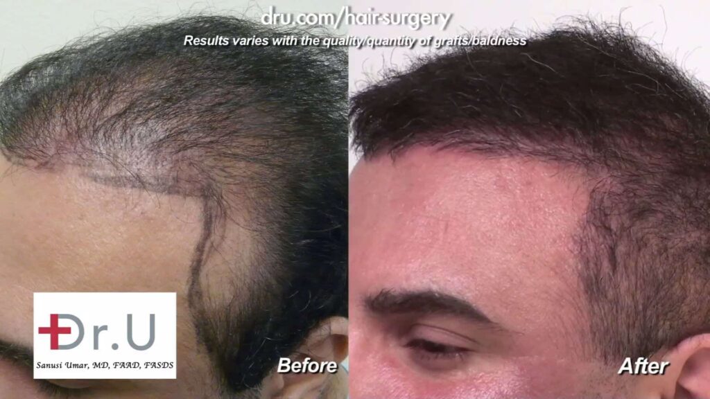 Hair repair using body hair transplant at the best corrective hair surgery doctor in the world