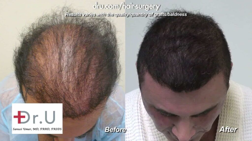 Dr. Umar was able to create the coverage this patient desired using his Dr. UGraft for Body Hair Transplant.*