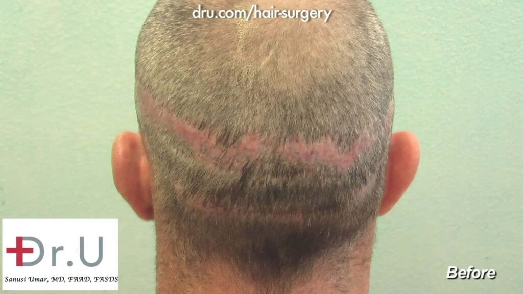 Before Dr. U performed a hair transplantation to cover the severe scarring from a previous strip FUSS surgery.
