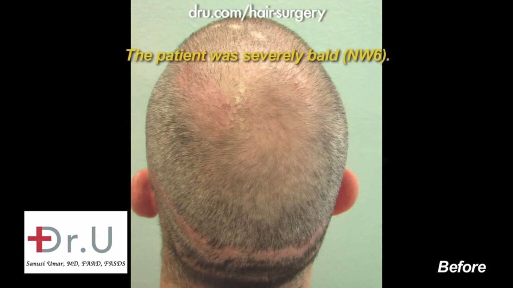 This patient was a 6 on the NW scale, he came to Dr. Umar to fix this.