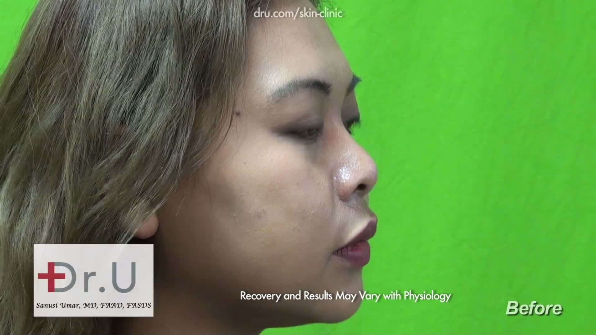 Before Radiesse nose filler was used
