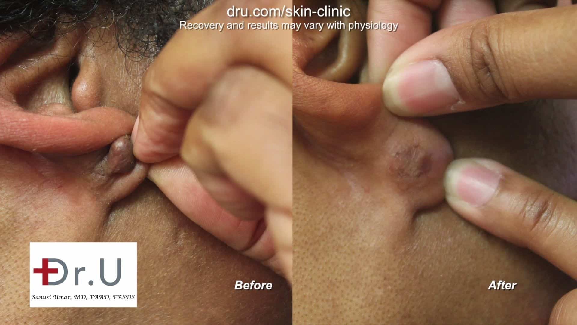 After Photo of Earlobe Keloid Removal Treatment After receiving earlobe keloid removal treatment, this Los Angeles patient is left with a keloid free earlobe a year after the surgery.