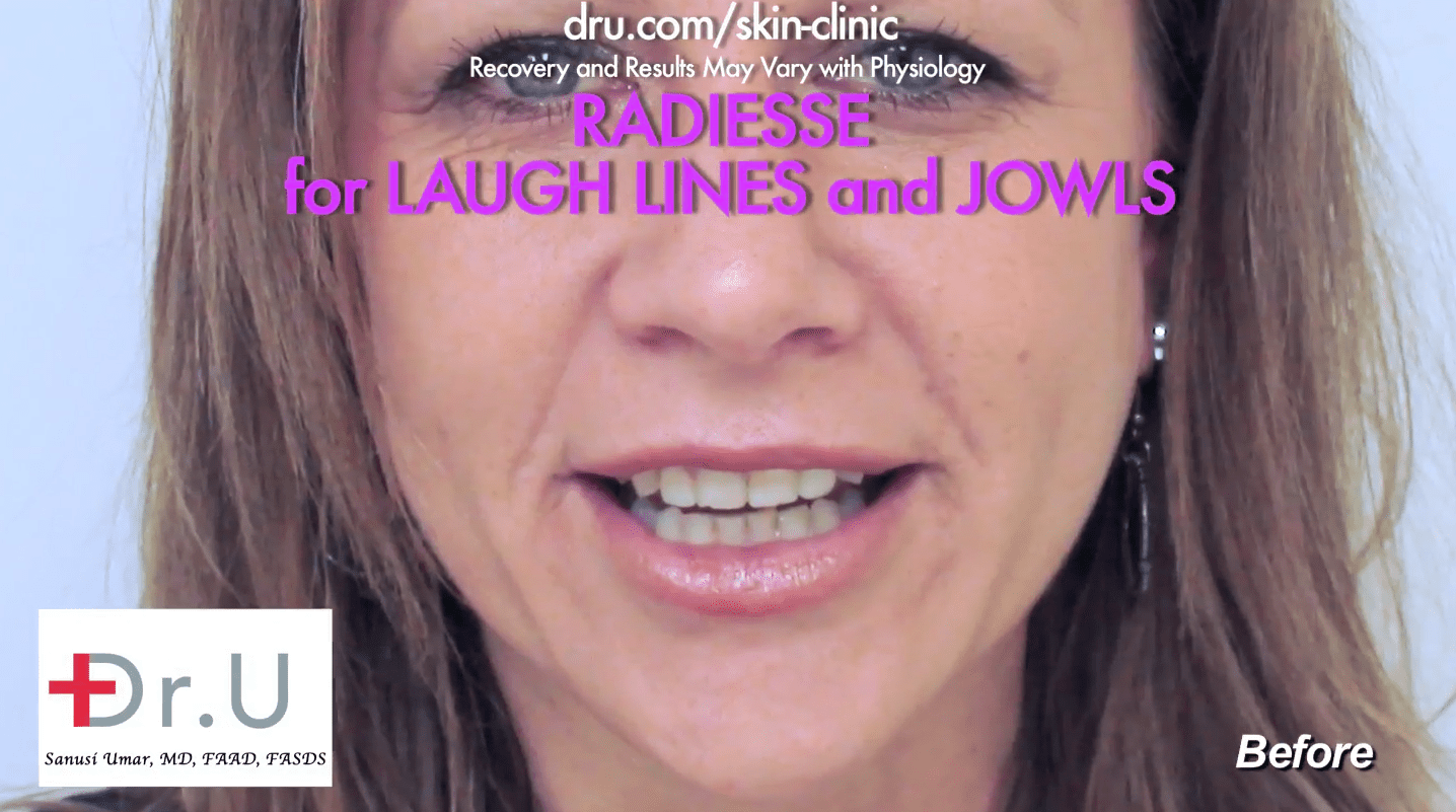 What are fillers? A smile line filler is another name for a laugh line filler. This patient received a laugh line reduction using dermal fillers. What are fillers? A smile line filler is another name for a laugh line filler. This patient received a laugh line reduction using dermal fillers.