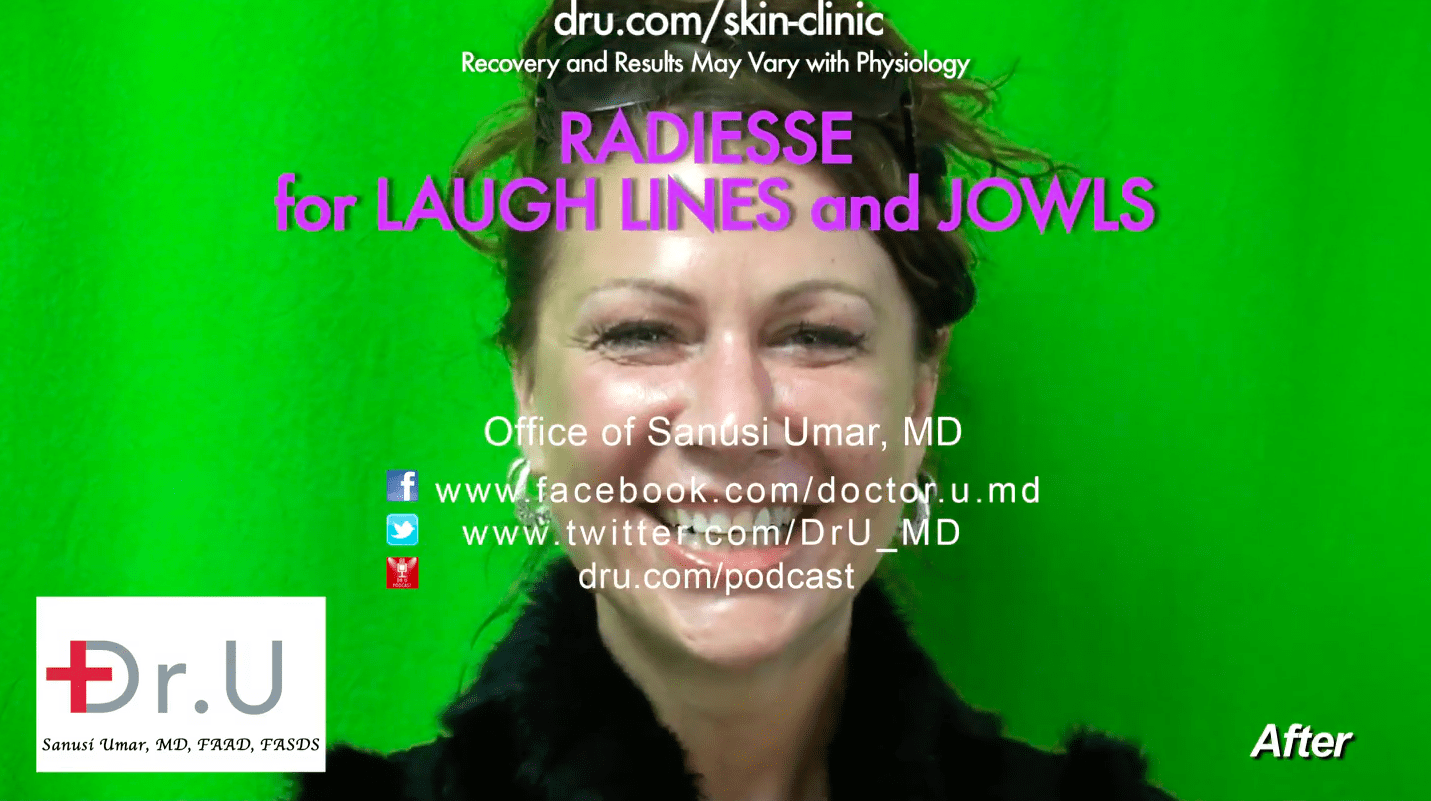 Radiesse treatment for laugh lines was a success. Radiesse treatment for laugh lines was a success.