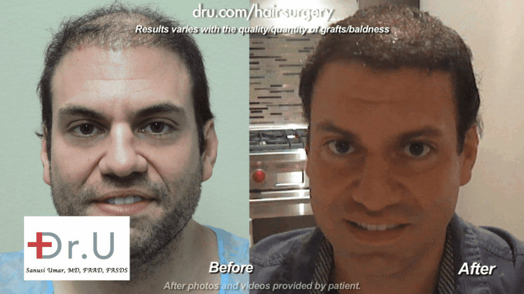 Here you can see the improved coverage the patient has after being treated with the Dr. Ugraft. *