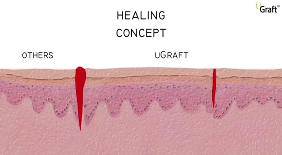 FUE transplant recovery: The DrUGraft leaves a smaller incision, and wounds heal in a month or less.