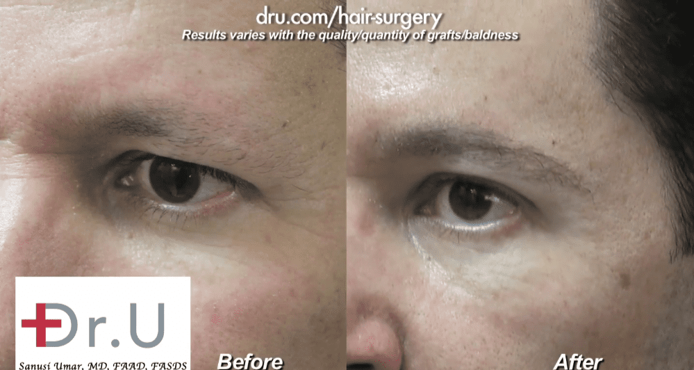 Dr.UGraft™’s ease of use when it comes to the utilization of body hair makes natural-looking eyebrow transplants a non-issue.*