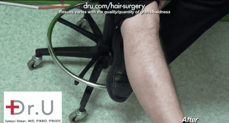 This patient's male eyebrow restoration with leg donor hair shows excellent healing results with no obvious or visible signs of scarring