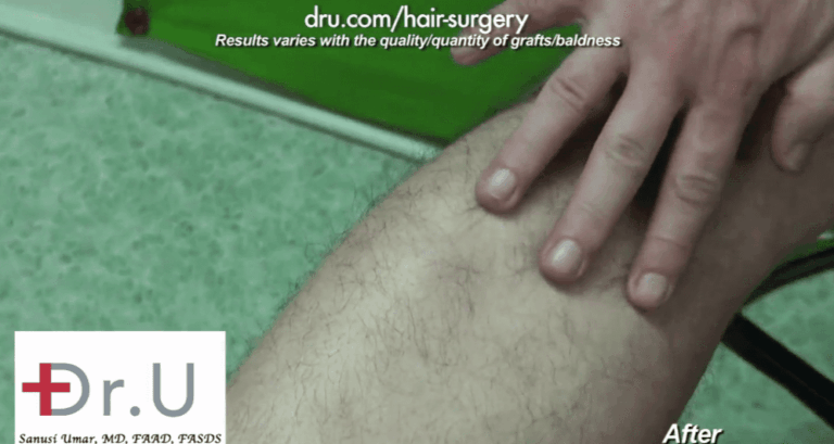 Leg donor area after surgical treatment for sparse brows shows excellent signs of healing 