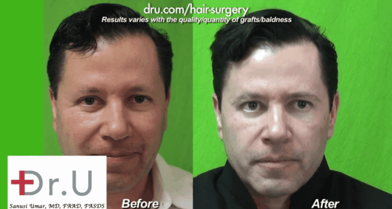 This patient's surgical treatment for sparse brows with leg hair made a significant difference in the overall appearance of his face.