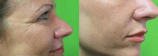 How to enhance lips: Lip fillers before and after How to enhance lips: Lip fillers before and after
