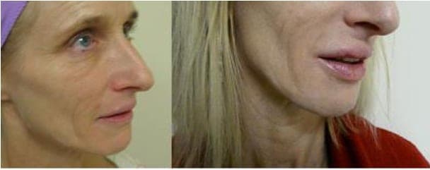 Natural lip enhancement Juvederm before and after Natural lip enhancement Juvederm before and after