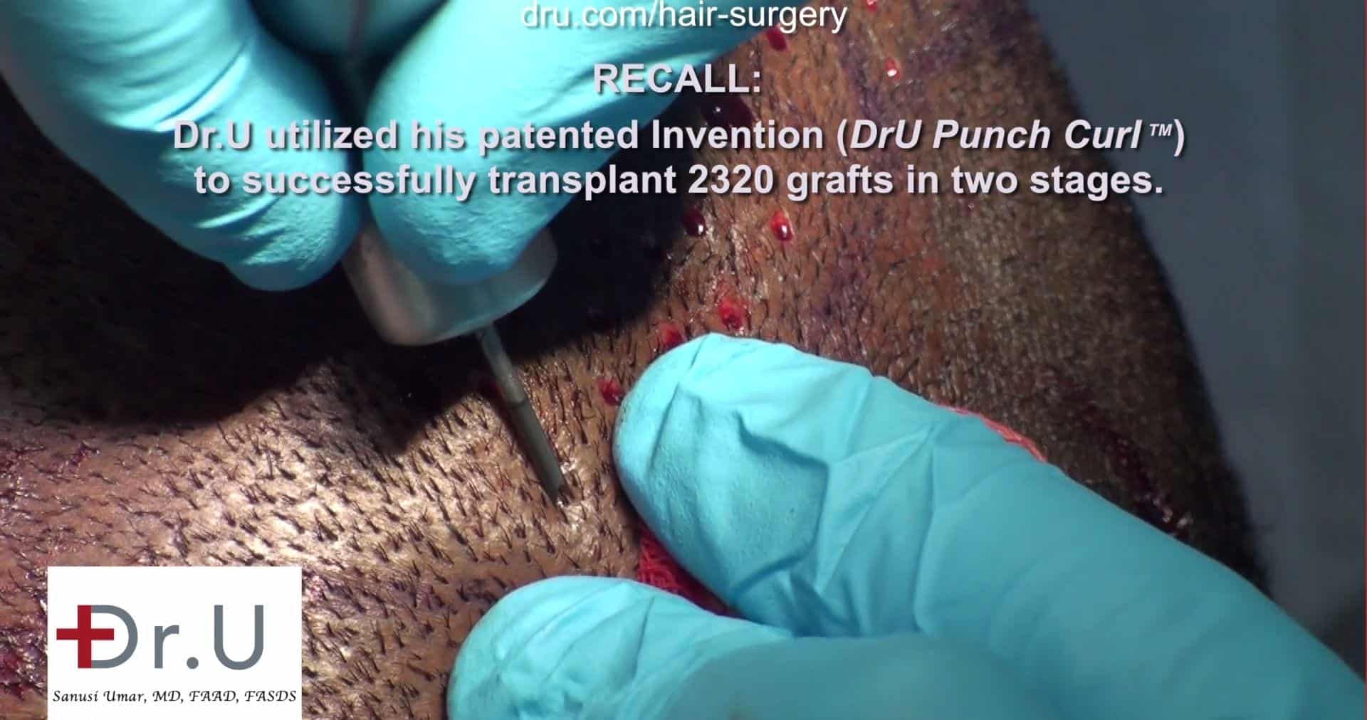 Fue hair transplant black male: Surgery process photo