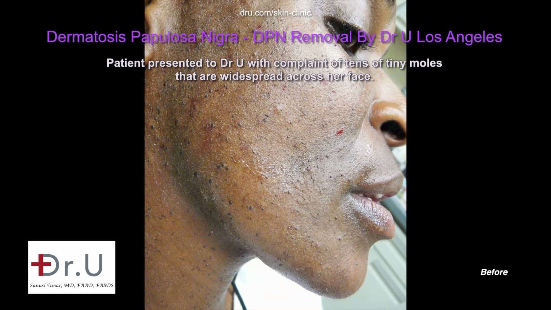 Patient before her DPN treatment