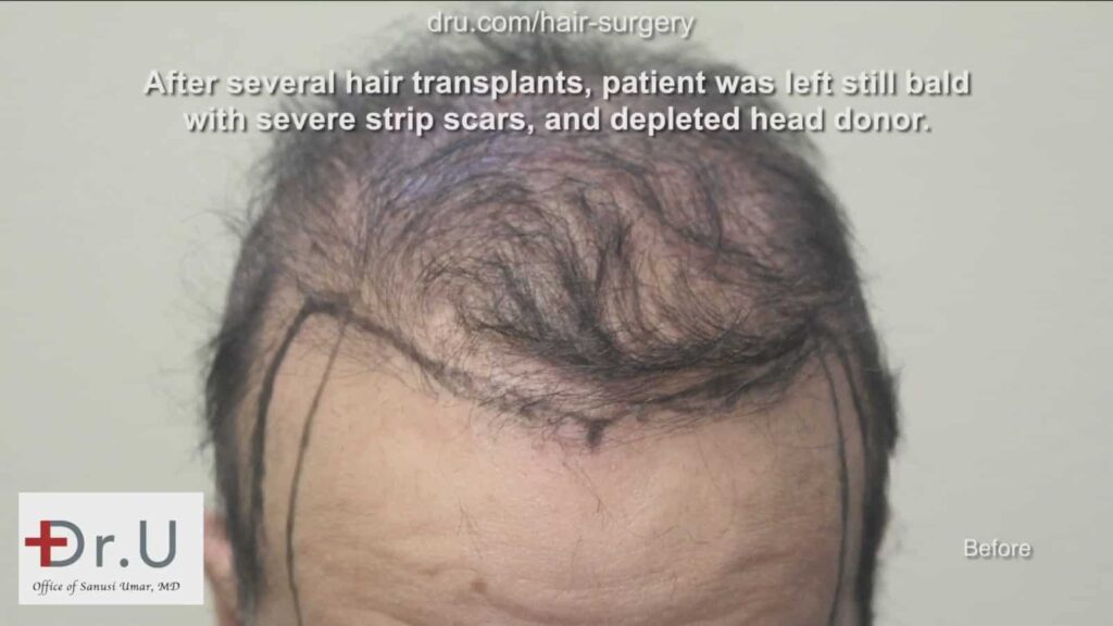 This patient asked himself, can a hair transplant really work for the hairline? Dr. Umar was able to come up with a realistic plan and graft count to create the changes that were desired.