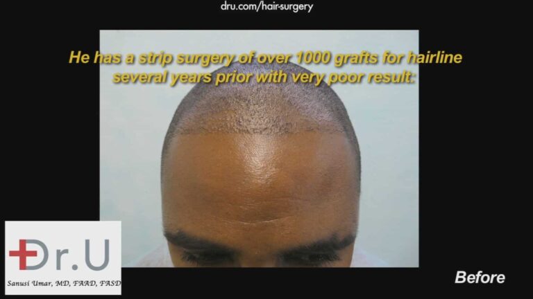 Receding hairlines in black men should be treated with specialized tools to help ensure the best yield possible. This African American patient did not experience the growth he wanted