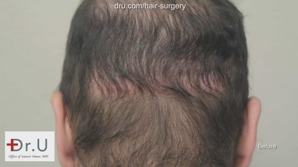Before Dr U Repair, patient had huge scars from past surgery and a depleted donor area