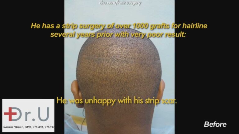 Strip hair transplantation for African Americans is often not compatible with the fact that many men of this demographic prefer very short hair styles. Therefore, linear scars are extremely visible 