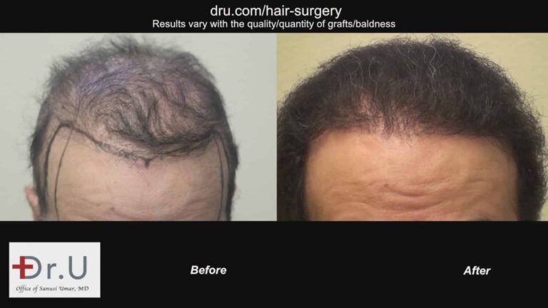  Dr.Umar restores entire head of hair using 1100 grafts taken from the scalp and the body. 