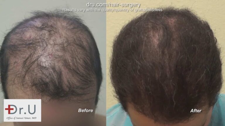 Before and after a Dr.UGraft hair transplant repair using 1100 donor grafts of body and head hair.