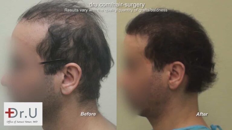 The Dr.UGraft can reverse the results of a poor hair transplant. This patient's case used body hair grafts for his bad hair transplant repair procedure