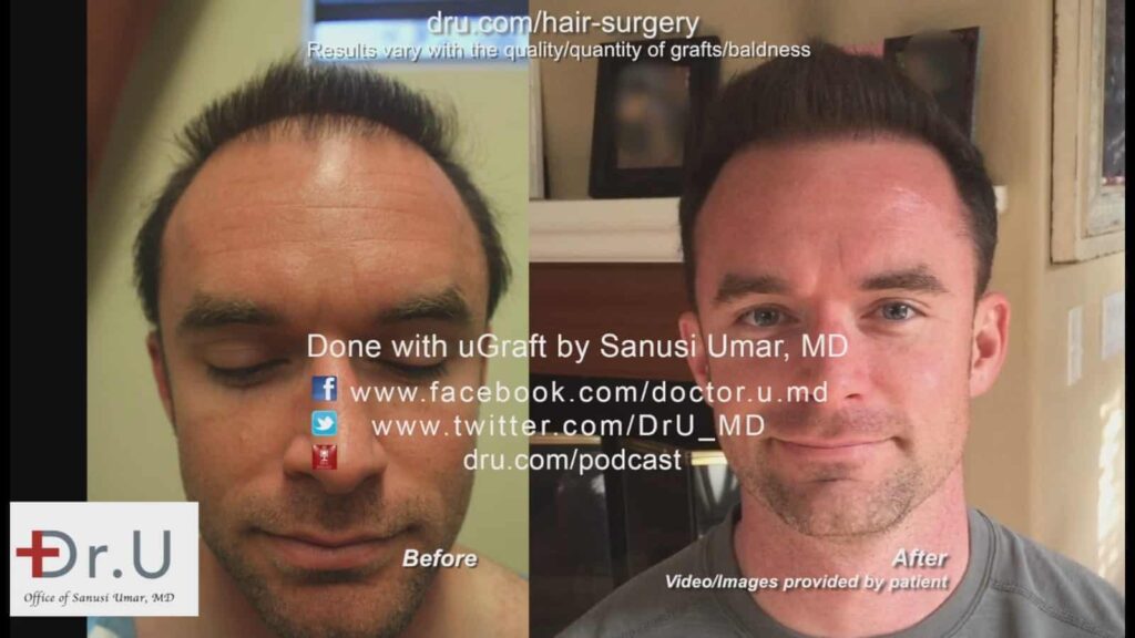 Front full facial view of patient's Dr.UGraft ™ hair transplant results , showing that the procedure was able to fix poor strip surgery growth by enabling the right number of grafts to provide the desired level of coverage