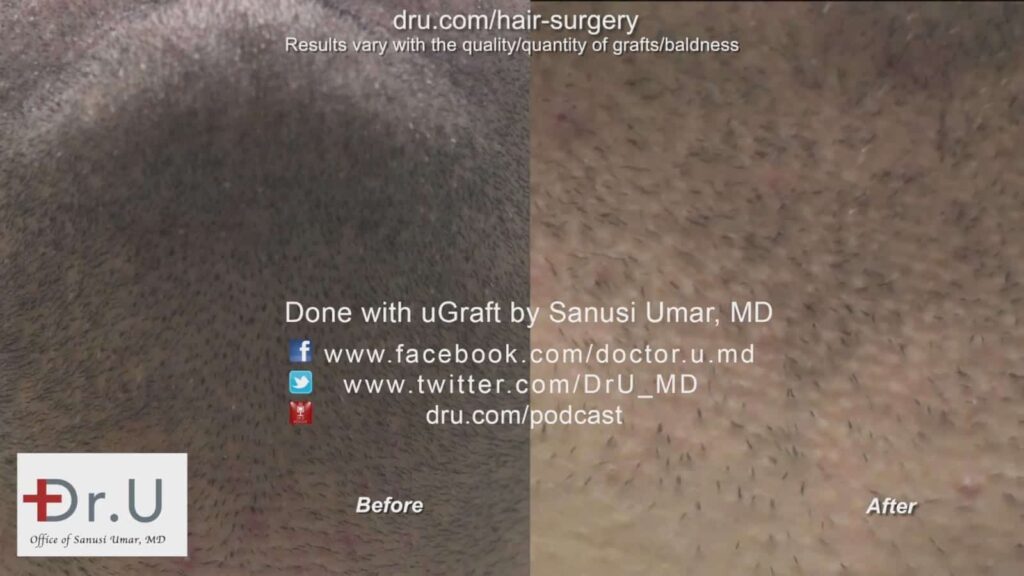 This photo shows how the patient's beard looked after Dr. Umar extracted hair for a hair transplant using beard hair.*