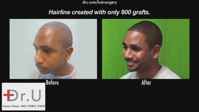 The results the Dr.UGrafti™ system is able to achieve speak for themselves.*