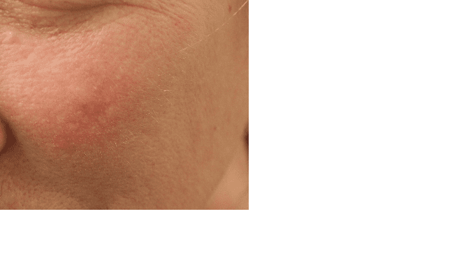 Scar removal before and after