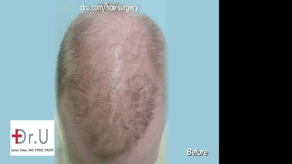 After hair transplant at another clinic, the patient was left with an asymmetric hairline and frontal scalp