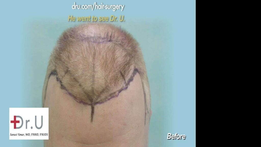 Before each procedure Dr. U maps out where the hair needs to be extracted.