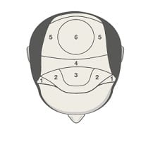 A bald scalp divided into 6 zones that can be used to estimate cost of hair restoration on a per zone basis