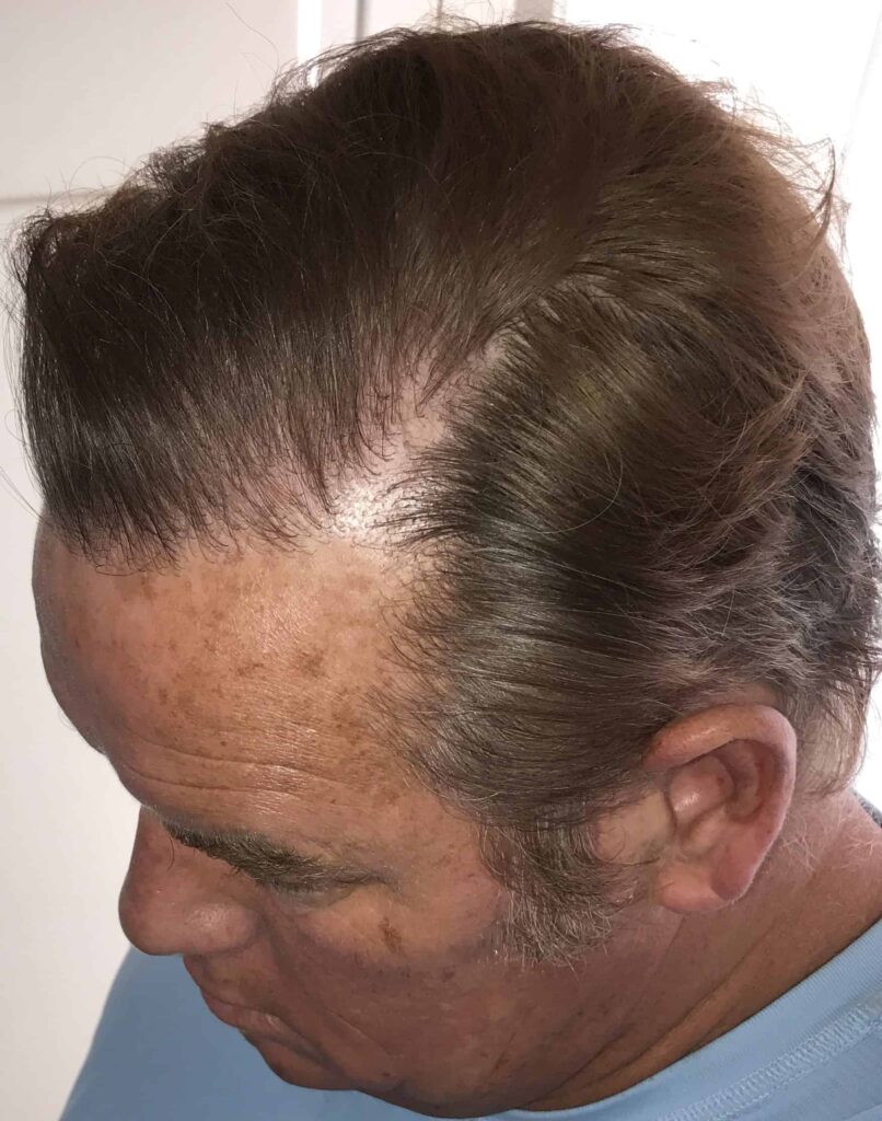 After treatment, the patient had no obvious signs of surgery, just a thick head of hair! After treatment, the patient had no obvious signs of surgery, just a thick head of hair!