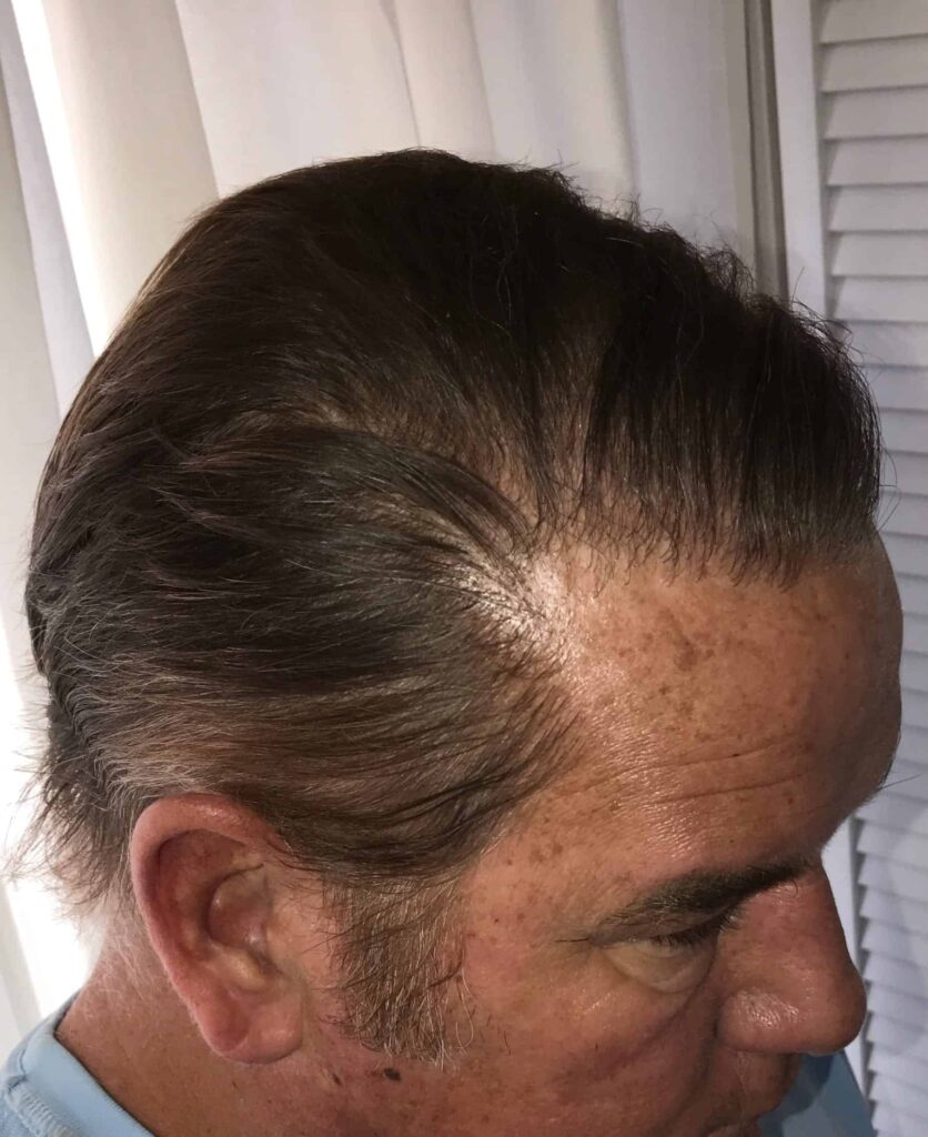 Even at the hairline and temple area, results of the Dr.UGraft look totally natural Even at the hairline and temple area, results of the Dr.UGraft look totally natural