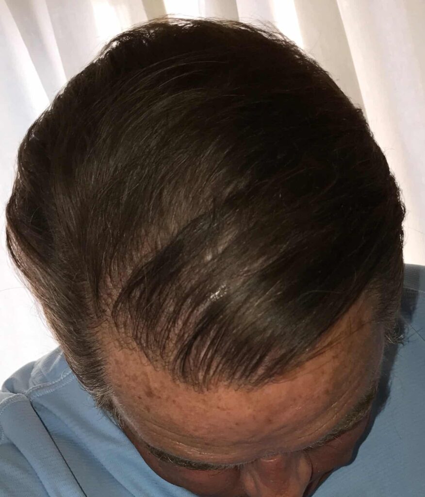 This patient felt great about his results after treatment. This patient felt great about his results after treatment.