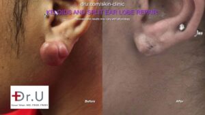 Successful split ear repair surgery in Los Angeles