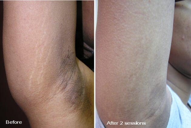 Can stretch marks be removed? Fraxel Laser for stretch mark removal after 2 sessions. (Not a Dr. U Skin Clinic Patient)