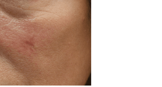 Can you get a scar removed from the face?