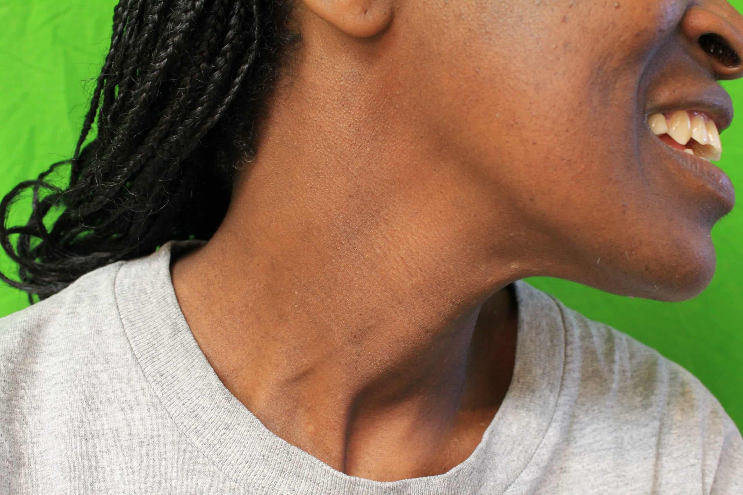 What happens after DPN removal healing