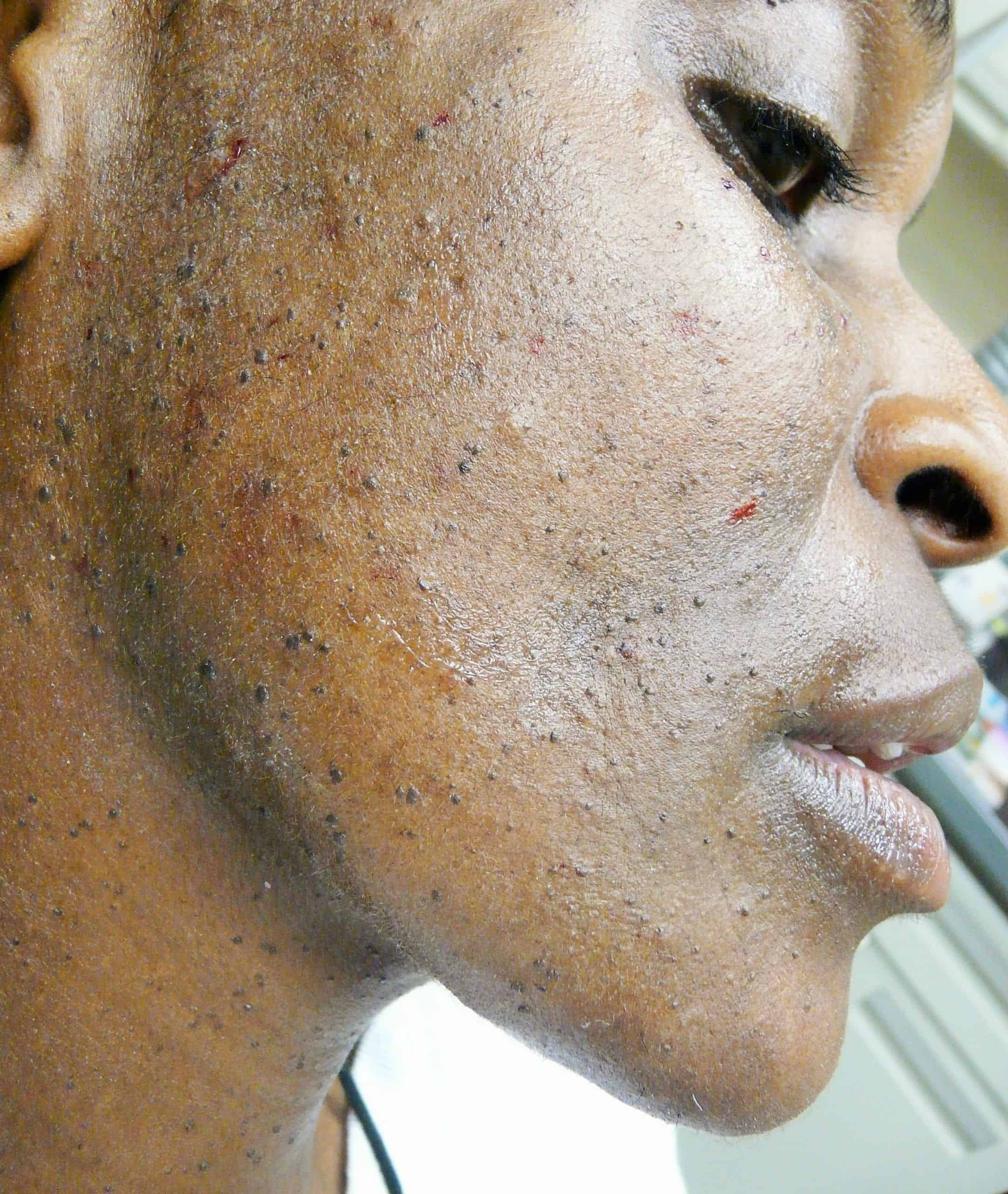 Photo showing lack of DPN skin prevention