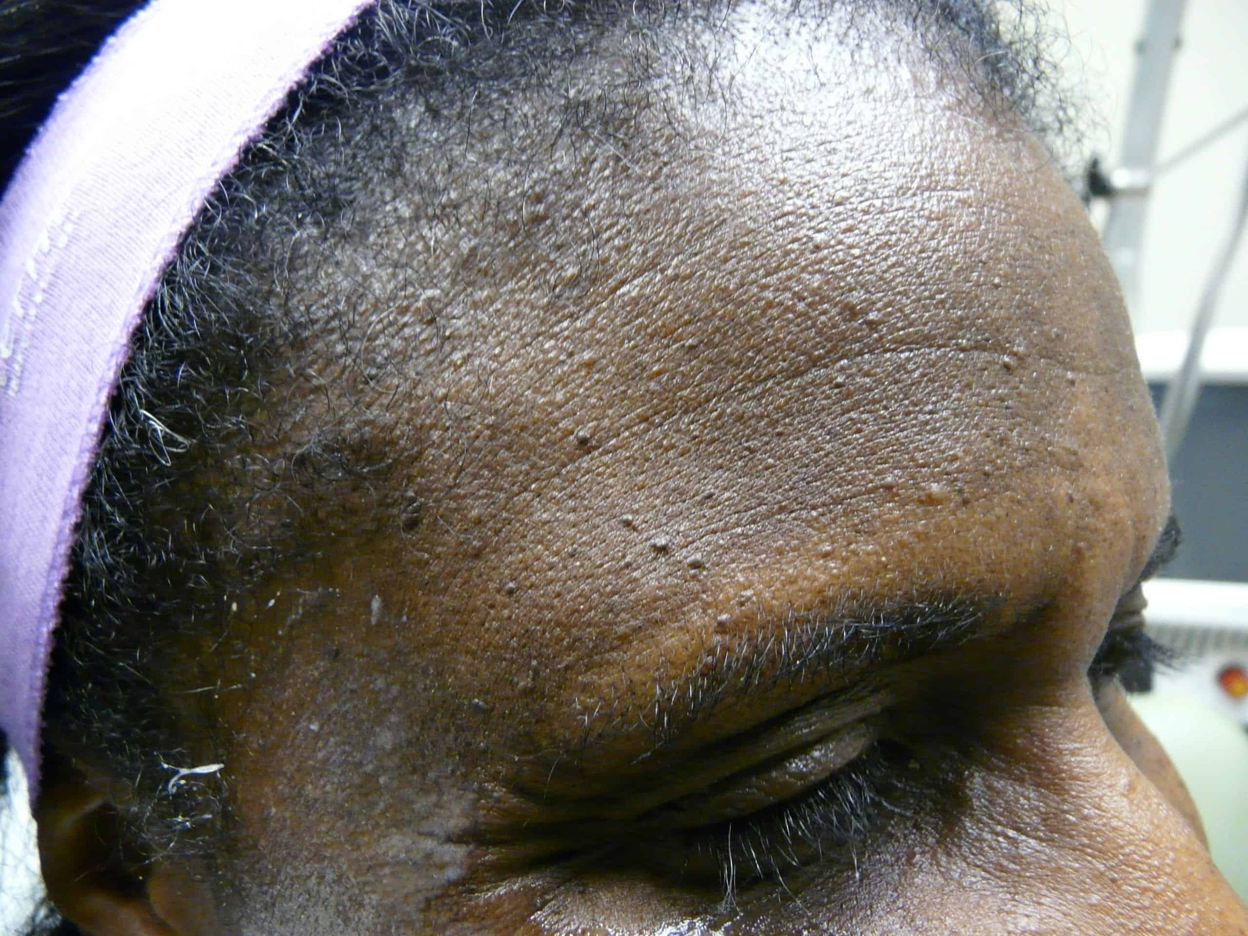 DPN removal before treatment with Dr. Umar.