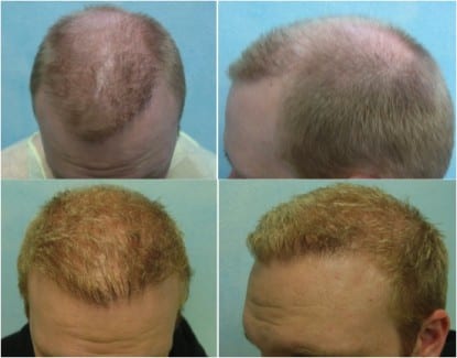 Hair Transplant Tourism is Not Cheaper in the long run: This California patient received an FUE treatment in India to save cost elsewhere and it resulted in a uneven hairline and continued loss of hair. He then had it fixed by Dr. Umar in Los Angeles