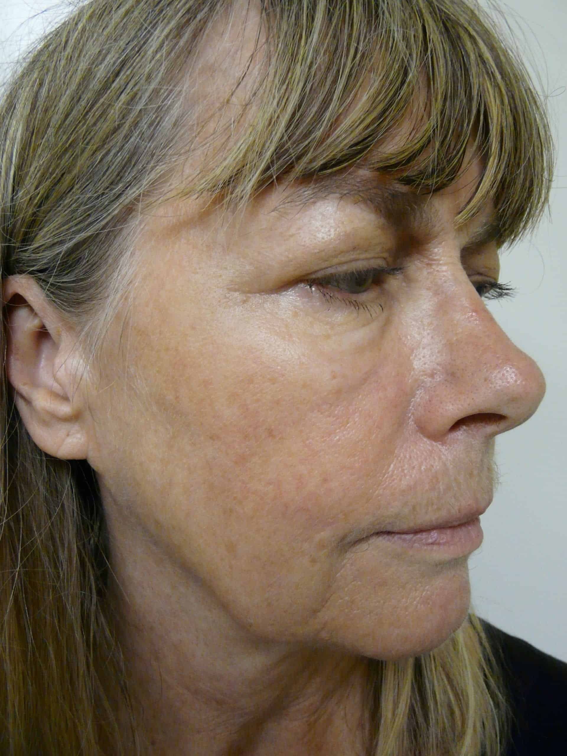 Radiesse - Best treatment for sagging jawline.