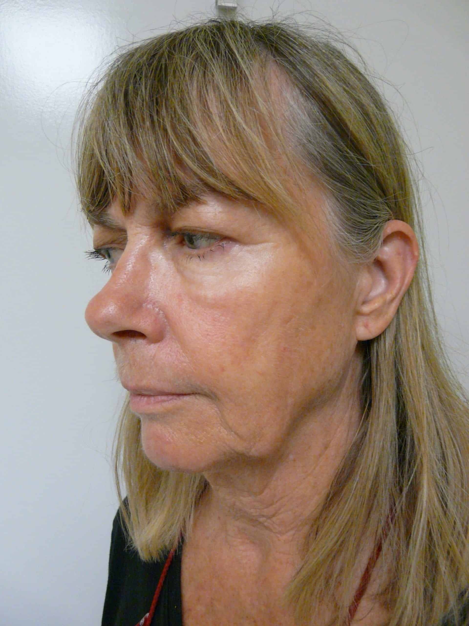 How do I get rid of my jowls?