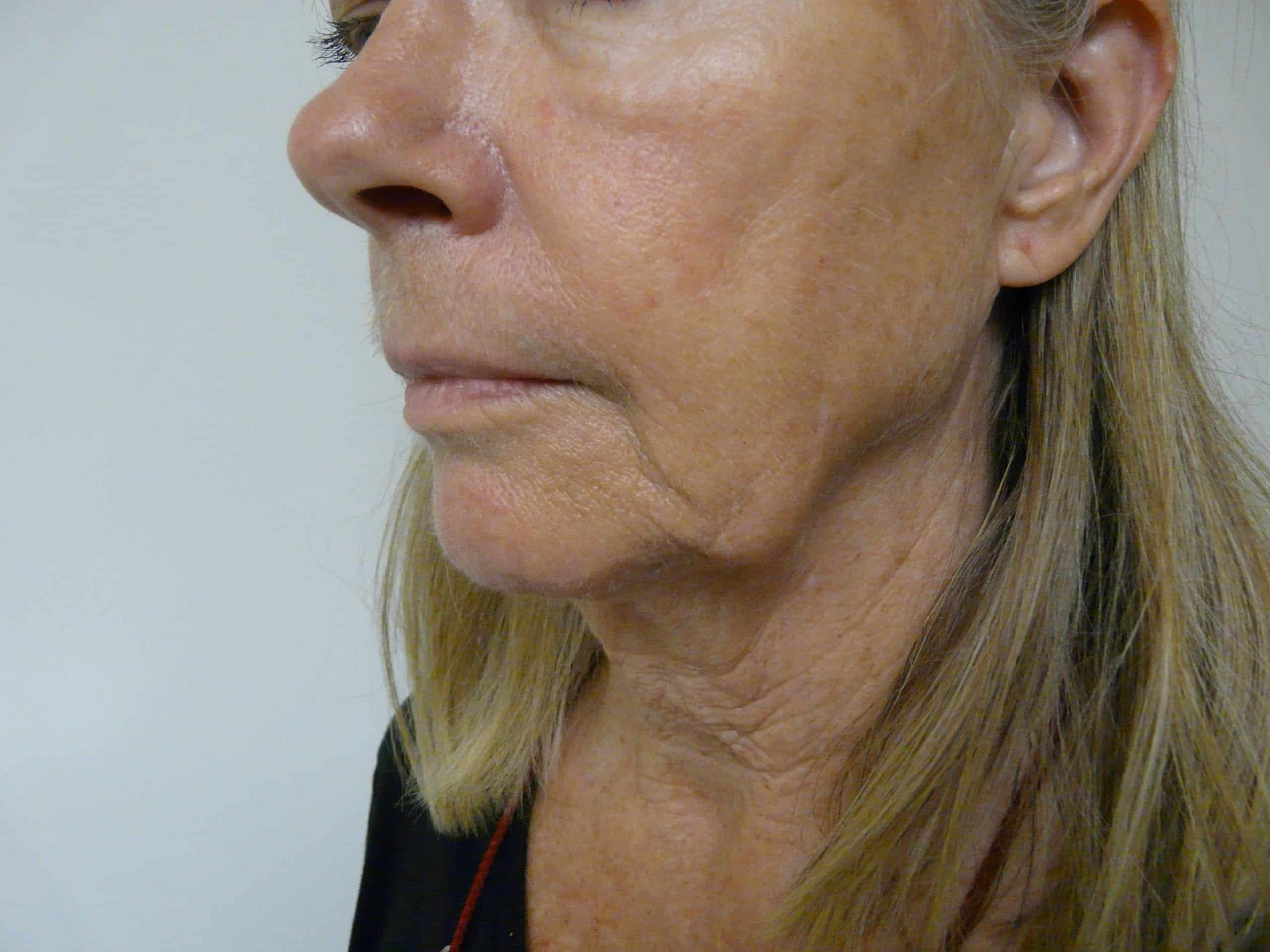 Non surgical jaw lift - before Radiesse