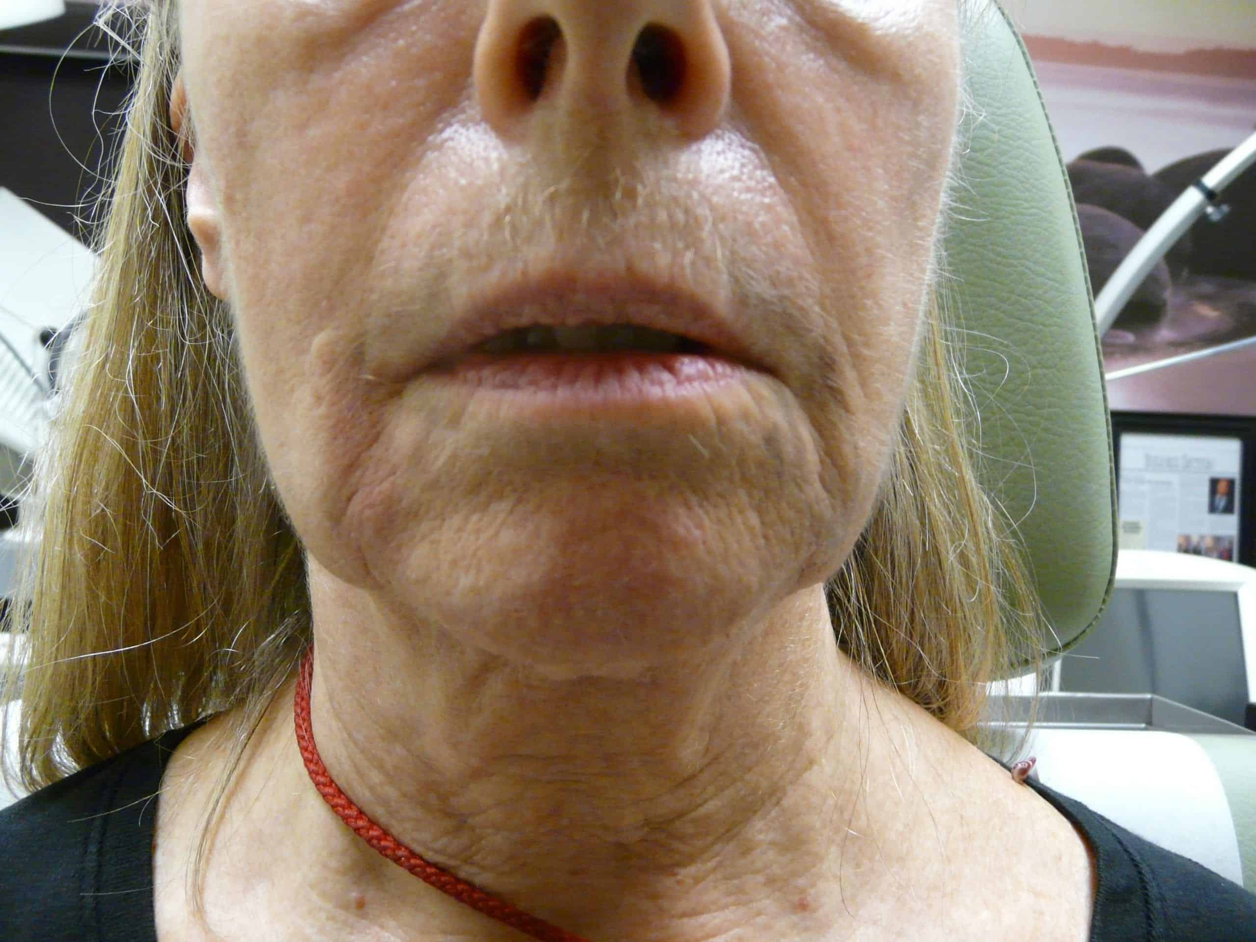 Radiesse for non surgical jaw lift.