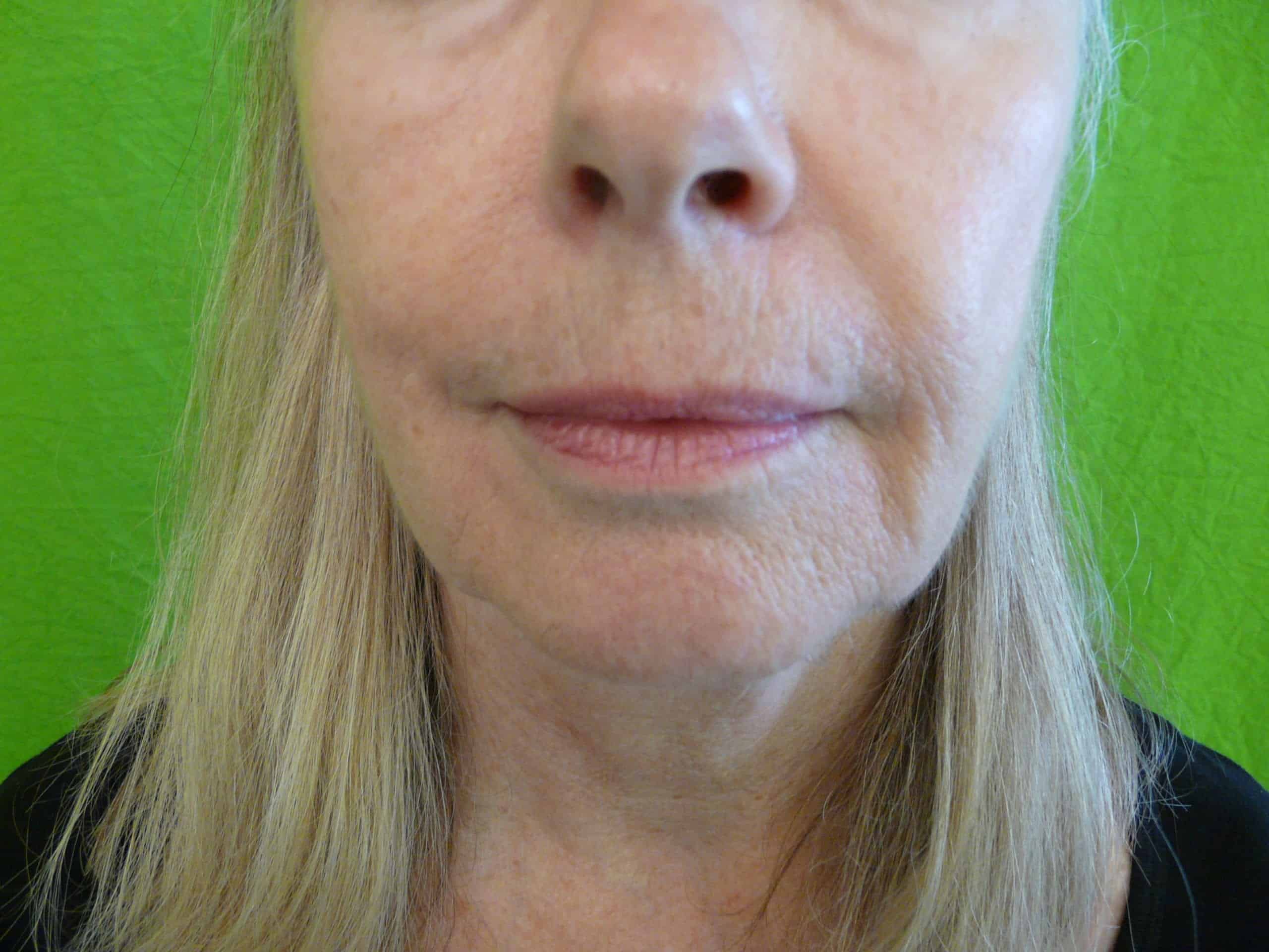Best Treatment for a Sagging Jawline: Remove jowls with dermal fillers.