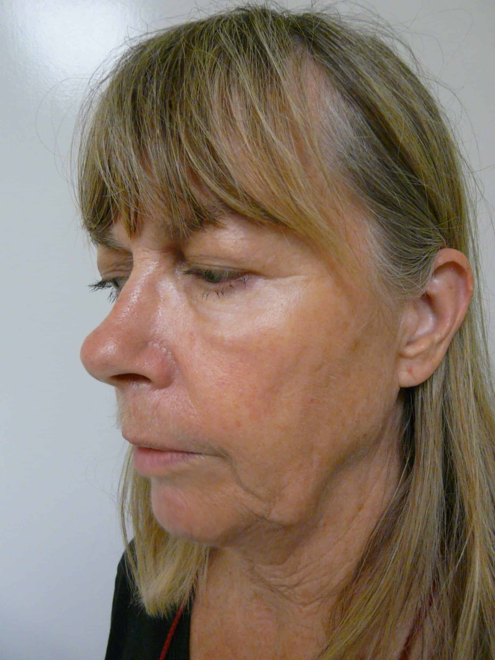 The patient’s picture before Dr. U’s jowl reduction without surgery. The patient’s picture before Dr. U’s jowl lift without surgery.